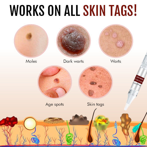 Last Day Promotion: Get 65% OFF on WipeOff's Tags & Moles Remover!